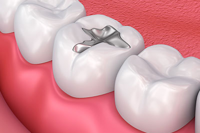 NoblePro Dental | Air Abrasion, Ceramic Crowns and E4D