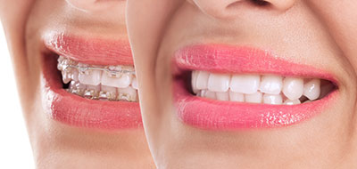 NoblePro Dental | Dentures, All-on-6 and Air Abrasion