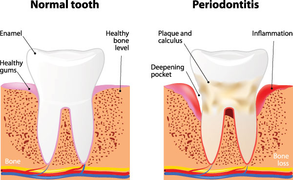 NoblePro Dental | Crowns  amp  Caps, Cosmetic Dentistry and ZOOM  Whitening