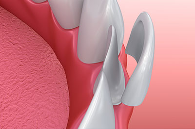 NoblePro Dental | All-on-4 reg , Air Abrasion and Ceramic Crowns